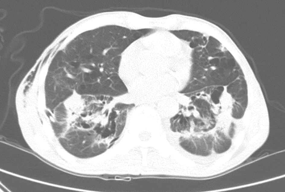 图6 原发性肺淀粉样变胸部CT表现-987bee32deaf4d62aca9e6306a77ab03.jpg